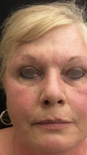 Under Eye Rejuvenation