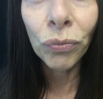 Botox Cosmetic and Dysport