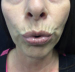 Botox Cosmetic and Dysport