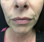 Botox Cosmetic and Dysport