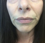 Botox Cosmetic and Dysport