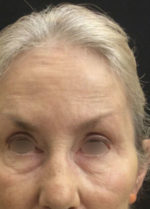 Botox Cosmetic and Dysport