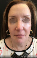 Botox Cosmetic and Dysport