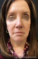 Botox Cosmetic and Dysport