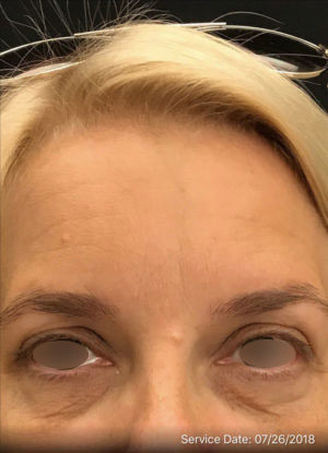 Botox Cosmetic and Dysport