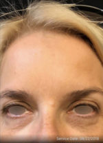 Botox Cosmetic and Dysport