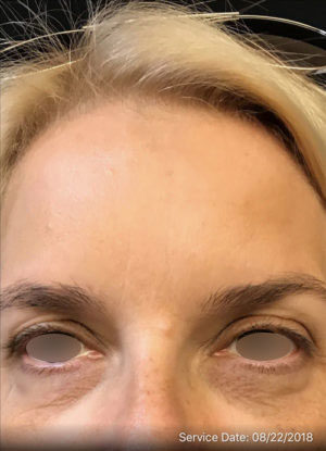 Botox Cosmetic and Dysport