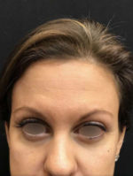 Botox Cosmetic and Dysport