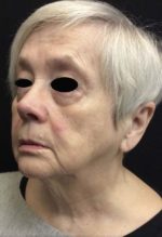 Sculptra