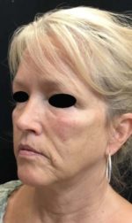 Sculptra