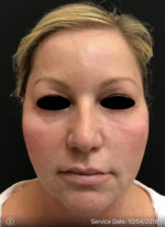 Under Eye Rejuvenation