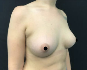 Breast Augmentation