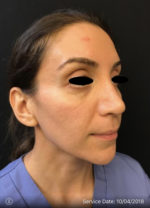 Sculptra