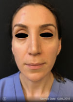 Sculptra