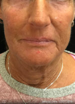 Periolar Filler