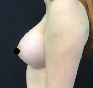 Breast Augmentation