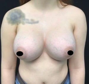 Breast Augmentation