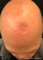 Squamous Cell Carcinoma