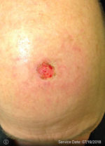 Squamous Cell Carcinoma