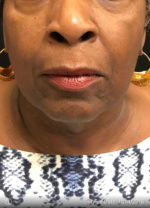 Periolar Filler