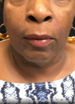 Periolar Filler