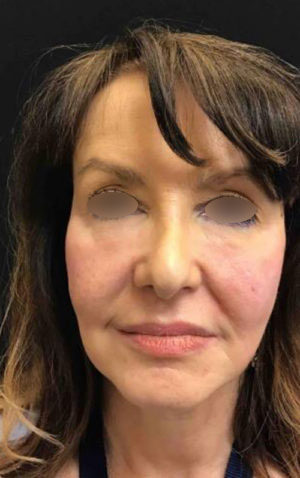 Under Eye Rejuvenation