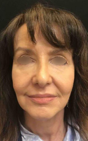 Under Eye Rejuvenation