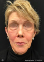 Under Eye Rejuvenation