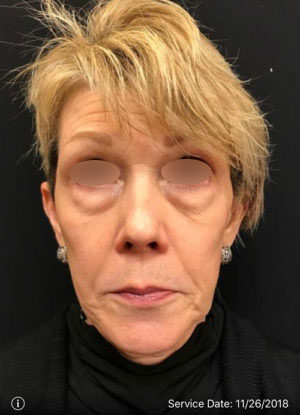 Under Eye Rejuvenation