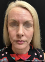 Under Eye Rejuvenation