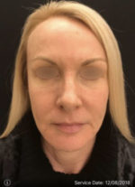 Under Eye Rejuvenation