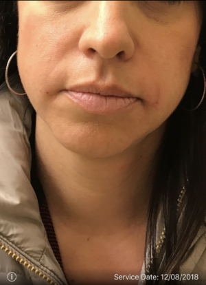 Periolar Filler