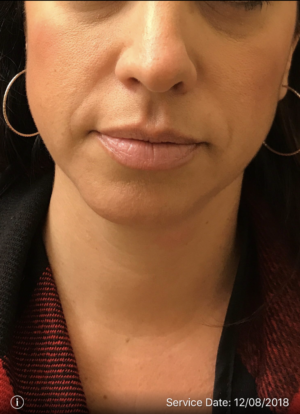 Periolar Filler