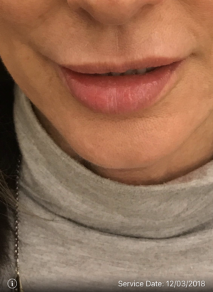 Juvederm