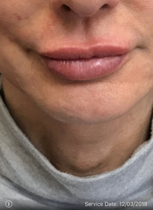 Juvederm