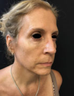 Around The Eye Fillers