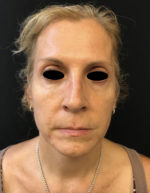 Around The Eye Fillers