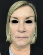 Around The Eye Fillers