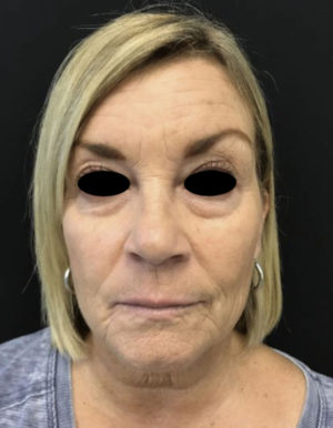 Around The Eye Fillers