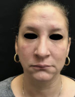 Around The Eye Fillers