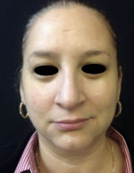 Around The Eye Fillers