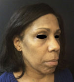 Around The Eye Fillers