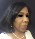 Around The Eye Fillers