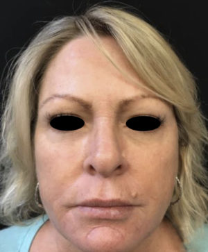 Around The Eye Fillers