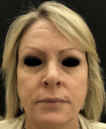 Around The Eye Fillers