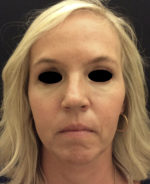 Around The Eye Fillers