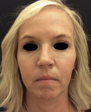 Around The Eye Fillers