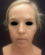 Around The Eye Fillers