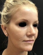 Around The Eye Fillers