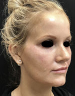 Around The Eye Fillers